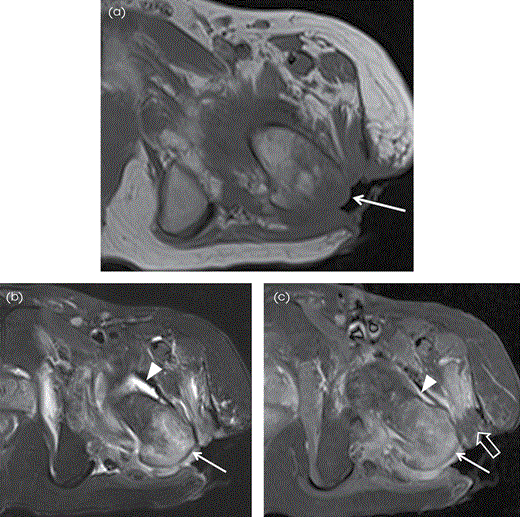 Contiguous focus OM in the left greater trochanter secondary to superficial ulcer in a 65-year-old man. (A) Axial T1W MR image shows large soft tissue defect/ulcer (arrow) by the greater trochanter with low signal in the adjacent soft tissues and in the greater trochanter. (B) Axial STIR MR image shows increased signal in the greater trochanter (arrow) and surrounding soft tissues with associated left hip joint effusion (arrowhead). (C) Corresponding axial postcontrast T1W FS MR image shows enhancement in the affected greater trochanter (arrow) and the soft tissues with enhancing synovitis (arrowhead) in the left hip. Note nonenhancing devitalized tissue (block arrow).