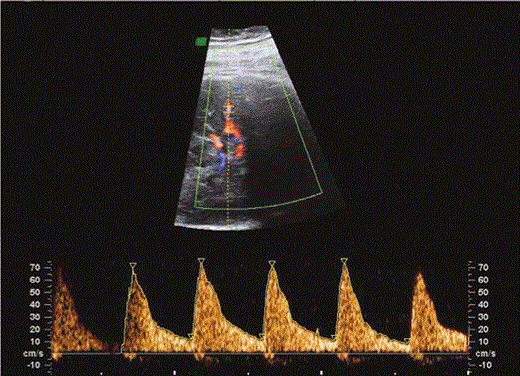 Measurement of the middle cerebral artery.