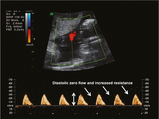 Zero flow of the umbilical artery.