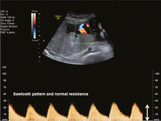 Normal flow of the umbilical artery.